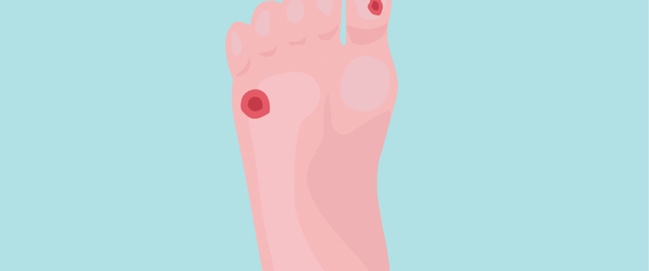 	
Diabetes and Feet – Cellulitis